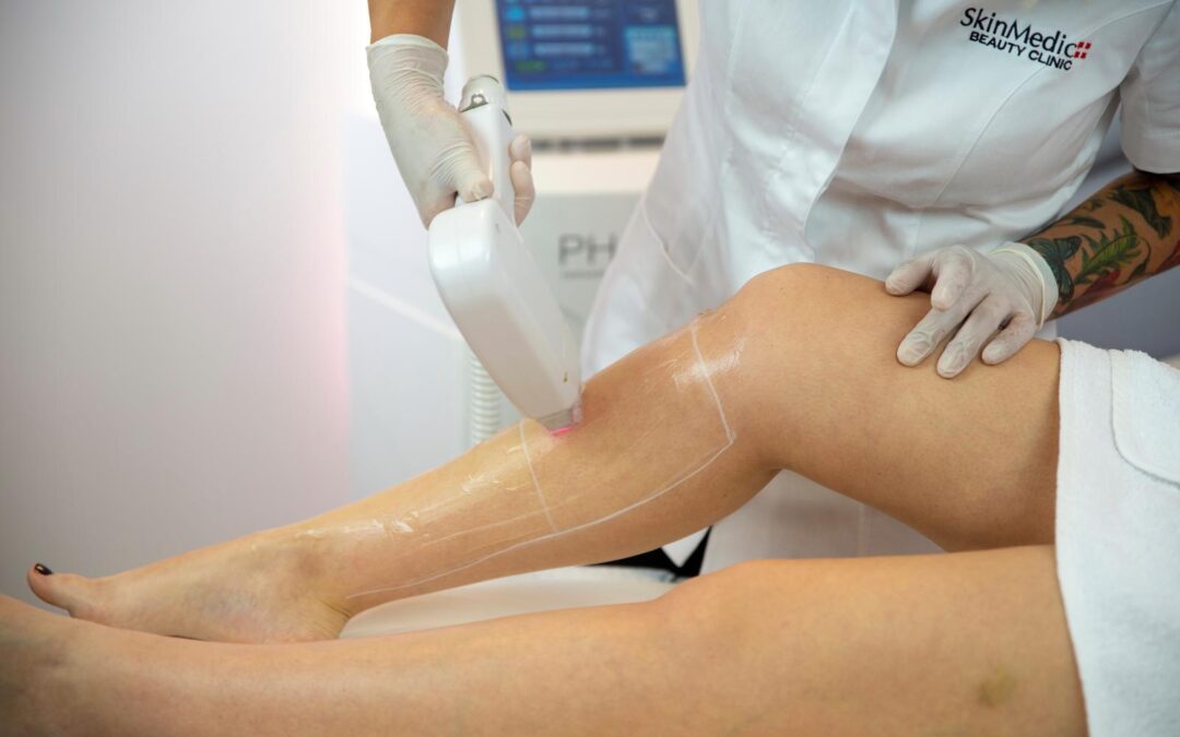 Follicolite da ceretta: cos’è e come prevenirla con l’epilazione laser